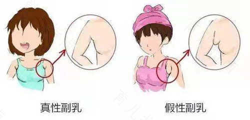 怎么把副乳去掉